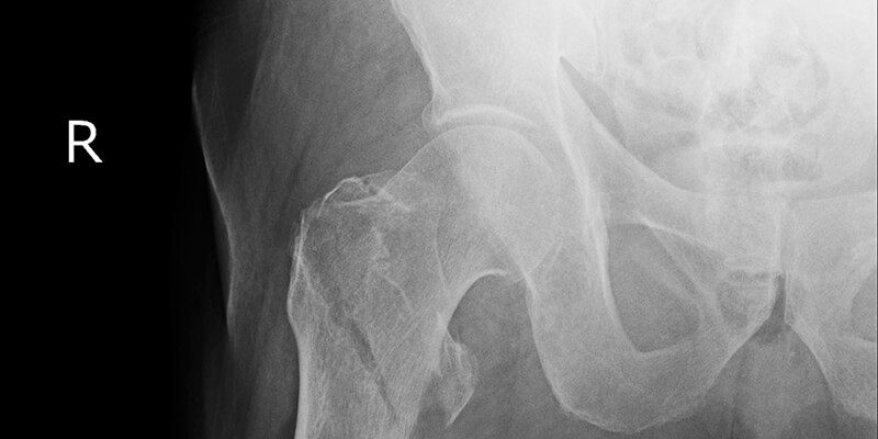 Osteoporosis ¿es posible prevenirla?